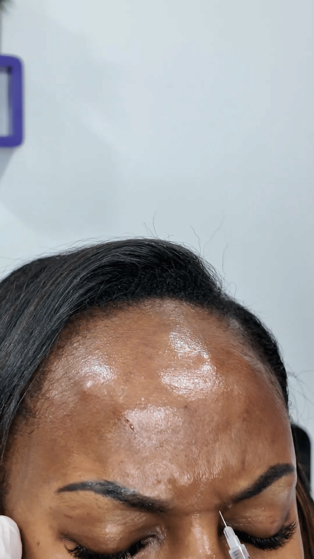 Glabella injections
