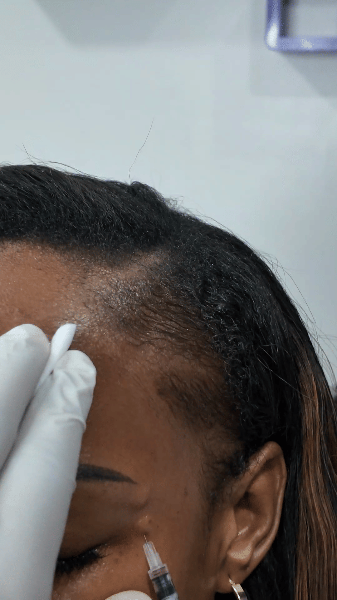 Forehead & Frown Line Injections