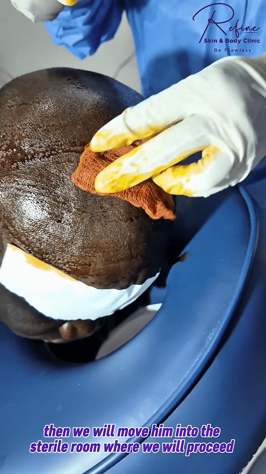 Hair Transplant at Refine