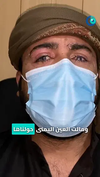 تبديل القرنيتين بين العينين: زراعة قرنية ذاتية بلا متبرع